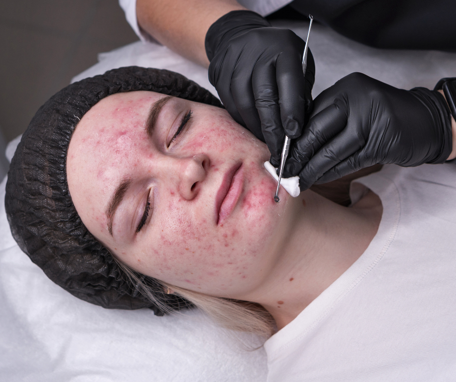 You are currently viewing Preferred Facials for Blackhead Removal